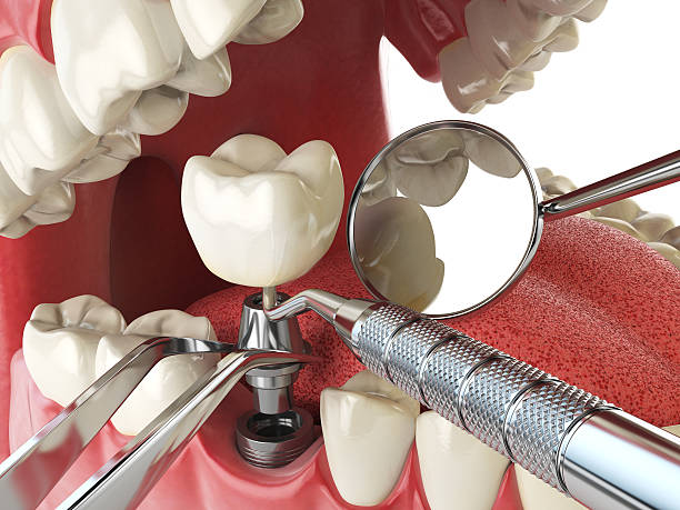 Best Emergency Treatment for Dental Infections or Abscesses in Lompoc, CA